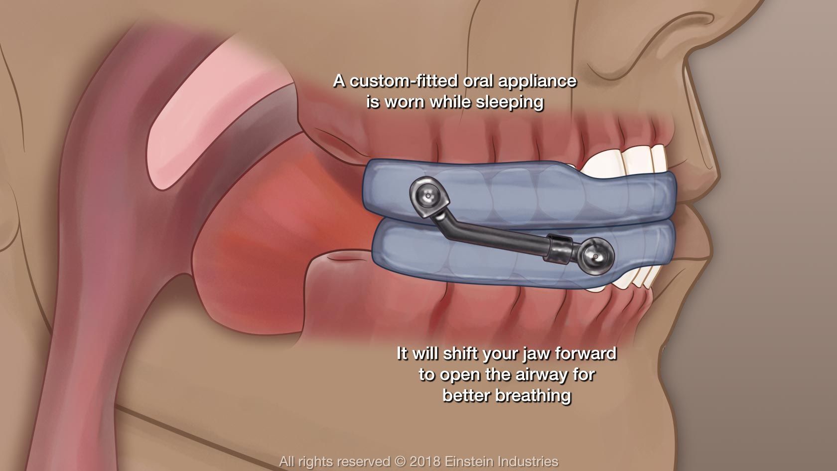 how oral appliances treat sleep apnea